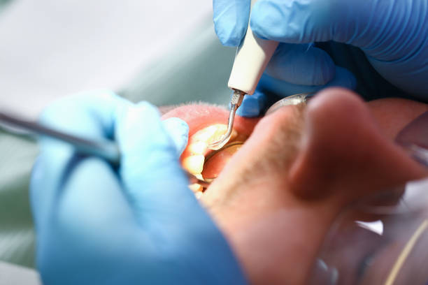 Best Emergency Dentist for Lost Fillings or Crowns in Galls, IN