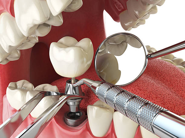 Best Emergency Root Canal Treatment in Galls, IN